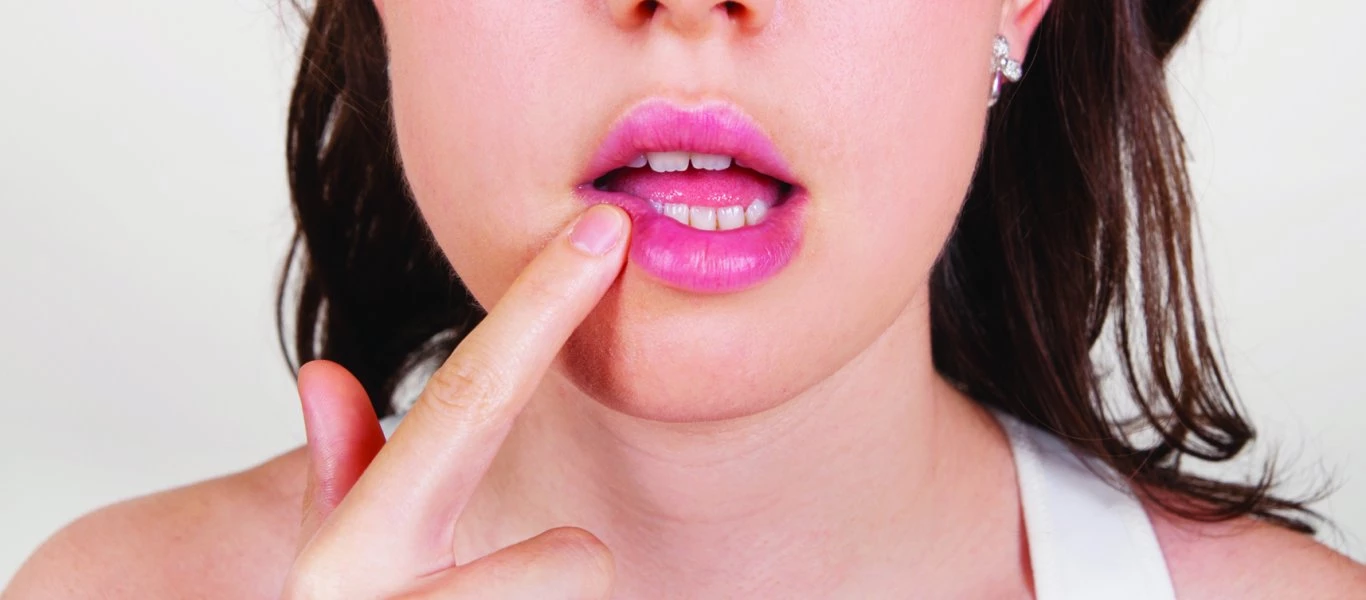 Επιχείλιος έρπης: Αίτια, συμπτώματα, αντιμετώπιση και πρόληψη